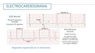 c
ELECTROCARDIOGRAMA
Diagnostico requiere ECG de 12 derivaciones
 