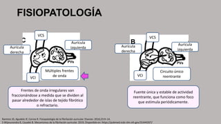 FISIOPATOLOGÍA
Múltiples frentes
de onda
VCI
VCS
Aurícula
izquierda
Aurícula
derecha
Frentes de onda irregulares van
fraccionándose a medida que se dividen al
pasar alrededor de islas de tejido fibrótico
o refractario.
Ramirez JD, Agudelo JF, Correa R. Fisiopatología de la fibrilación auricular. Elsevier. 2016;23:9–14.
S Wijesurendra R, Casadei B. Mecanismos de la fibrilación auricular. 2019; Disponible en: https://pubmed.ncbi.nlm.nih.gov/31444267/
Fuente única y estable de actividad
reentrante, que funciona como foco
que estimula periódicamente.
Aurícula
izquierda
Aurícula
derecha
VCS
VCI
Circuito único
reentrante
 