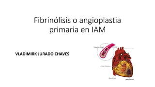 Fibrinólisis o angioplastia
primaria en IAM
VLADIMIRK JURADO CHAVES
 