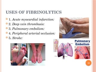 10
USES OF FIBRINOLYTICS
 1. Acute myocardial infarction:
 2. Deep vein thrombosis:
 3. Pulmonary embolism:
 4. Peripheral arterial occlusion:
 5. Stroke:
 