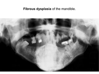 Fibrous dysplasia of the mandible.
 