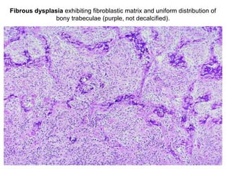 Fibrous dysplasia exhibiting fibroblastic matrix and uniform distribution of
bony trabeculae (purple, not decalcified).
 