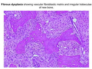 Fibrous dysplasia showing vascular fibroblastic matrix and irregular trabeculae
of new bone.
 