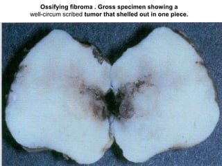 Ossifying fibroma . Gross specimen showing a
well-circum scribed tumor that shelled out in one piece.
 