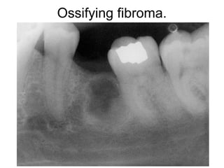 Ossifying fibroma.
 