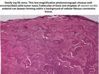 Ossify ing fib roma. This low-magnification photomicrograph showsa well-
circumscribed solid tumor mass.Trabeculae of bone and droplets of cement um-like
material can beseen forming within a background of cellular fibrous connective
tissue.
 