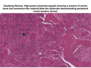 Ossifying fibroma. High-power photomicrograph showing a mixture of woven
bone and cementum-like material.Note the spherules demonstrating peripheral
brush borders (arrow)
 