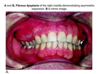 A and B, Fibrous dysplasia of the right maxilla demonstrating asymmetric
expansion. B is mirror image.
 