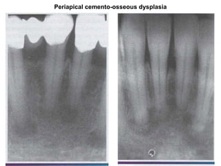 Periapical cemento-osseous dysplasia
 
