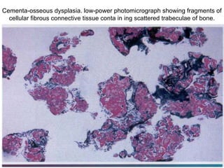Cementa-osseous dysplasia. low-power photomicrograph showing fragments of
cellular fibrous connective tissue conta in ing scattered trabeculae of bone.
 