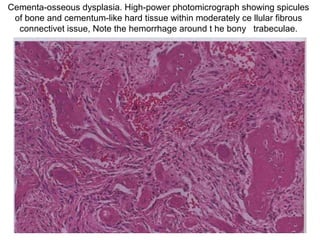 Cementa-osseous dysplasia. High-power photomicrograph showing spicules
of bone and cementum-like hard tissue within moderately ce llular fibrous
connectivet issue, Note the hemorrhage around t he bony trabeculae.
 