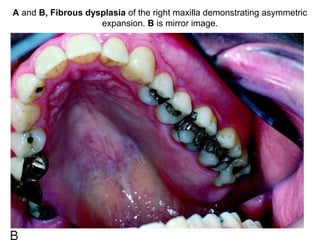 A and B, Fibrous dysplasia of the right maxilla demonstrating asymmetric
expansion. B is mirror image.
 