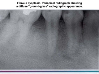 Fibrous dysplasia. Periapical radiograph showing
a diffuse "ground-glass" radiographic appearance.
 