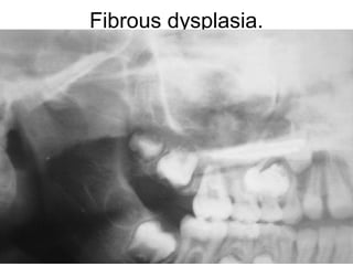 Fibrous dysplasia.
 