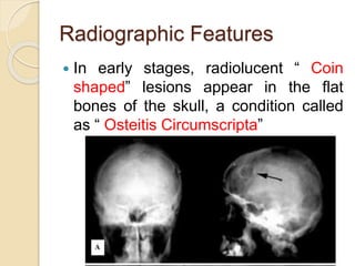Radiographic Features 
 In early stages, radiolucent “ Coin 
shaped” lesions appear in the flat 
bones of the skull, a condition called 
as “ Osteitis Circumscripta” 
 