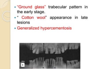  “Ground glass” trabecular pattern in 
the early stage. 
 “ Cotton wool” appearance in late 
lesions 
 Generalized hypercementosis 
 