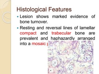 Histological Features 
 Lesion shows marked evidence of 
bone turnover. 
 Resting and reversal lines of lamellar 
compact and trabecular bone are 
prevalent and haphazardly arranged 
into a mosaic pattern. 
 
