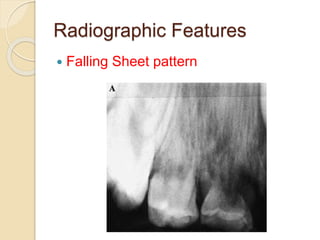 Radiographic Features 
 Falling Sheet pattern 
 