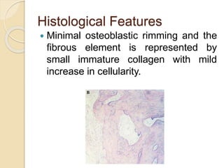 Histological Features 
 Minimal osteoblastic rimming and the 
fibrous element is represented by 
small immature collagen with mild 
increase in cellularity. 
 