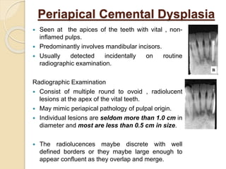 Periapical Cemental Dysplasia 
 Seen at the apices of the teeth with vital , non-inflamed 
pulps. 
 Predominantly involves mandibular incisors. 
 Usually detected incidentally on routine 
radiographic examination. 
Radiographic Examination 
 Consist of multiple round to ovoid , radiolucent 
lesions at the apex of the vital teeth. 
 May mimic periapical pathology of pulpal origin. 
 Individual lesions are seldom more than 1.0 cm in 
diameter and most are less than 0.5 cm in size. 
 The radiolucences maybe discrete with well 
defined borders or they maybe large enough to 
appear confluent as they overlap and merge. 
 