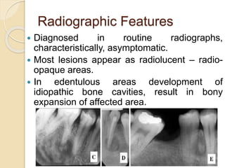 Radiographic Features 
 Diagnosed in routine radiographs, 
characteristically, asymptomatic. 
 Most lesions appear as radiolucent – radio-opaque 
areas. 
 In edentulous areas development of 
idiopathic bone cavities, result in bony 
expansion of affected area. 
 