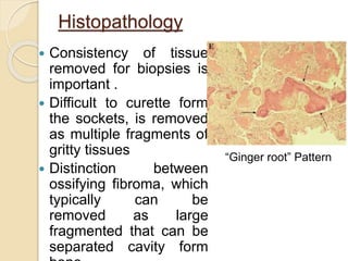 Histopathology 
 Consistency of tissue 
removed for biopsies is 
important . 
 Difficult to curette form 
the sockets, is removed 
as multiple fragments of 
gritty tissues 
 Distinction between 
ossifying fibroma, which 
typically can be 
removed as large 
fragmented that can be 
separated cavity form 
bone. 
“Ginger root” Pattern 
 