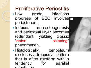 Proliferative Periostitis 
 Low grade infections 
progress of DSO involves 
periosteoum. 
 Induces neo-osteogenesis 
and periosteal layer becomes 
redundant, yielding classic 
“onion skinning” 
phenomenon. 
 Histologically, periosteum 
discloses a trabecular pattern 
that is often reteform with a 
tendency for parallel 
orientation 
 