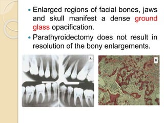  Enlarged regions of facial bones, jaws 
and skull manifest a dense ground 
glass opacification. 
 Parathyroidectomy does not result in 
resolution of the bony enlargements. 
 