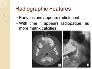 Radiographic Features 
 Early lesions appears radiolucent 
 With time it appears radiopaque, as 
more matrix calcifies. 
 