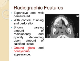 Radiographic Features 
 Expansive and well 
demarcated 
 With cortical thinning 
and perforation 
 Shows varying 
amount of 
radiolucency and 
opacity depending 
upon amount of 
calcified tissue. 
 Ground glass and 
honeycomb 
appearance. 
 
