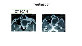 Investigation
CT SCAN
 