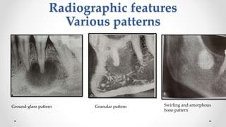 FIBRO-OSSEOUS LESIONS OF JAW(1).pptx UP.pptx