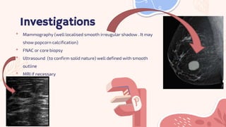 Investigations
• Mammography (well localised smooth irreugular shadow . It may
show popcorn calcification)
• FNAC or core ...
