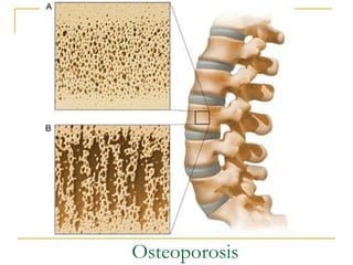 Osteoporosis
 