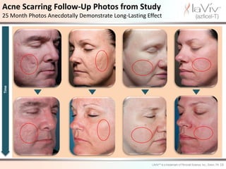 Acne Scarring Follow-Up Photos from Study
25 Month Photos Anecdotally Demonstrate Long-Lasting Effect
Time




                                                              16
 
