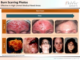 Burn Scarring Photos
Effective in High Unmet Medical Need Areas

                                                                   Burn Scars

                                                                    Time
    Case 1
    Case 2




 Note: Photos from LAVIV prescribers. Not from clinical studies.


                                                                                18
 