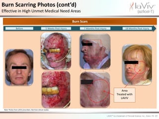 Burn Scarring Photos (cont’d)
Effective in High Unmet Medical Need Areas

                                                                                 Burn Scars
                 Before                                    5 Weeks Post Injury          7 Months Post Injury         18 Months Post Injury




                                                                                                                   Area
                                                                                                               Treated with
                                                                                                                  LAVIV


 Note: Photos from LAVIV prescribers. Not from clinical studies.


                                                                                                                                             19
 