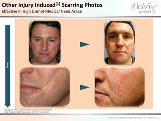 Other Injury Induced(1) Scarring Photos
Effective in High Unmet Medical Need Areas
   Time




 (1) Iraqi war veteran who sustained injuries as a result of shrapnel.
 Note: Photos from LAVIV prescribers. Not from clinical studies.


                                                                         20
 
