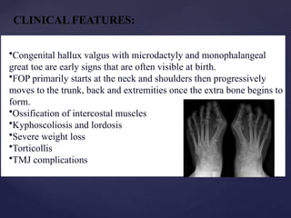 Microdactaly Comprehensive Overview of Fibrodysplasia Ossificans Progressiva (FOP ...