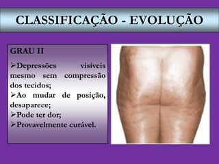 CLASSIFICAÇÃO - EVOLUÇÃO
GRAU II
Depressões visíveis
mesmo sem compressão
dos tecidos;
Ao mudar de posição,
desaparece;
Pode ter dor;
Provavelmente curável.
 