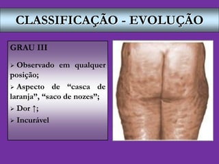 CLASSIFICAÇÃO - EVOLUÇÃO
GRAU III
 Observado em qualquer
posição;
 Aspecto de “casca de
laranja”, “saco de nozes”;
 Dor ↑;
 Incurável
 