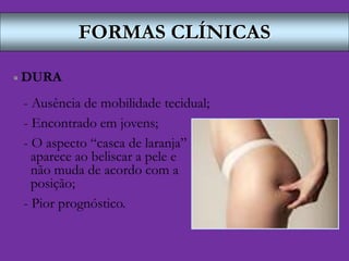 FORMAS CLÍNICAS
 DURA
- Ausência de mobilidade tecidual;
- Encontrado em jovens;
- O aspecto “casca de laranja”
aparece ao beliscar a pele e
não muda de acordo com a
posição;
- Pior prognóstico.
 