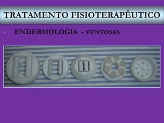 TRATAMENTO FISIOTERAPÊUTICO
 ENDERMOLOGIA - VENTOSAS
 