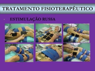 TRATAMENTO FISIOTERAPÊUTICO
 ESTIMULAÇÃO RUSSA
 
