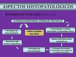 ASPECTOS HISTOPATOLÓGICOS
 ESTÁGIOS DE EVOLUÇÃO (Guirro, 2004)
ALTERAÇÃO ESFINCTERIANA ARTERIOLAR PRÉ-CAPILAR
Transudação e edema
pericapilar e interadipocitário
Edema dificulta trocas
metabólicas
Formação de Vacúolos
Pluricelulares dos adipósitos
q/ sofrem laceração
Formação de
micronódulos
Esclerose das
traves conjuntivas
Formação de
macronódulos
FIBRO EDEMA
GELÓIDE
 