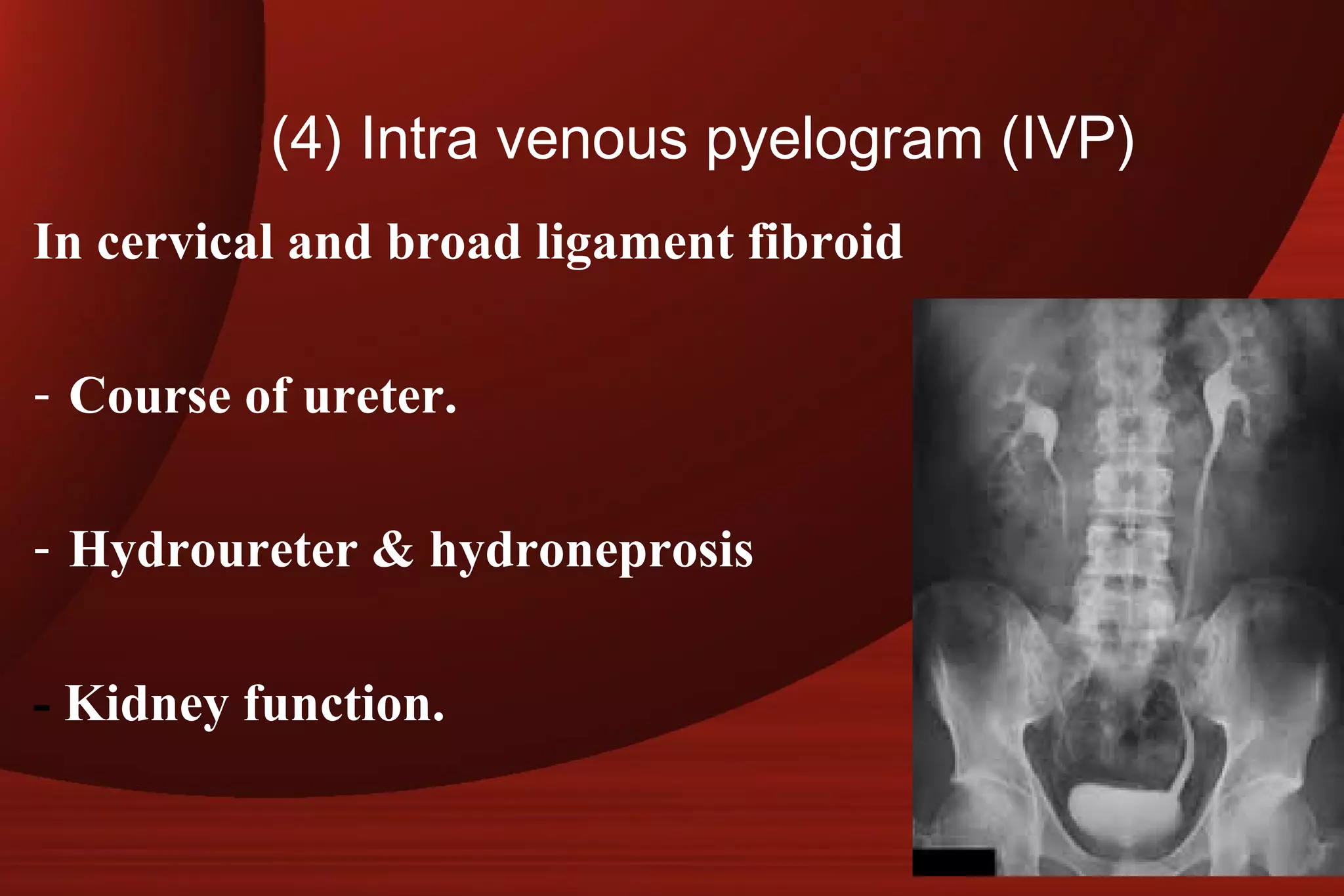 Pylelogram Fibroid uterus | PPT