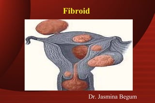 Fibroid
Dr. Jasmina Begum
 