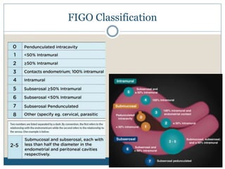 Myome Classification Uterine Fibroid / Uterine Leiomyoma / Indore Infertility | PPTX
