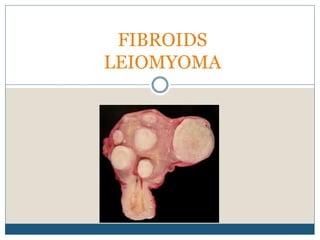 FIBROIDS
LEIOMYOMA
 