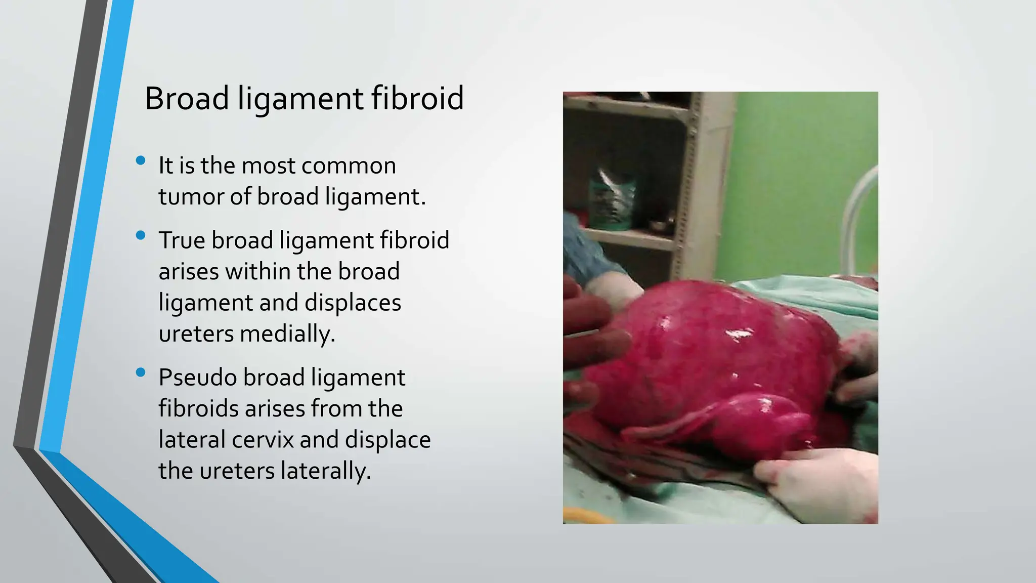 Broad ligament fibroid
• It is the most common
tumor of broad ligament.
• True broad ligament fibroid
arises within the broad
ligament and displaces
ureters medially.
• Pseudo broad ligament
fibroids arises from the
lateral cervix and displace
the ureters laterally.
 